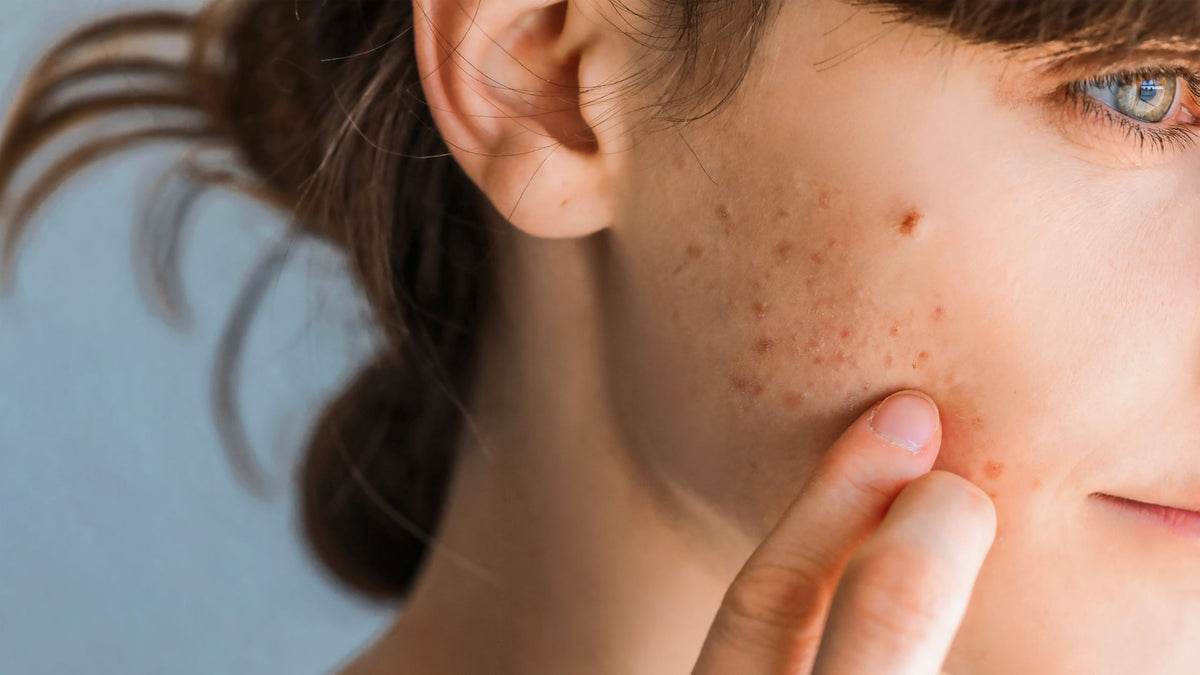 Top Tips for Acne with Skin Expert Edele