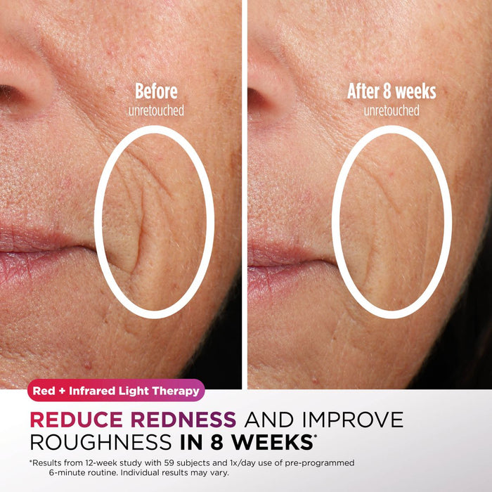 Shark CryoGlow Under-Eye Cooling & LED Anti-Ageing & Blemish Repair Mask Lilac Chill