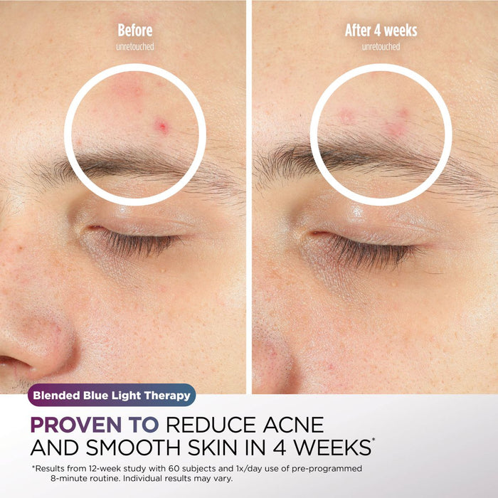 Shark CryoGlow Under-Eye Cooling & LED Anti-Ageing & Blemish Repair Mask Lilac Chill