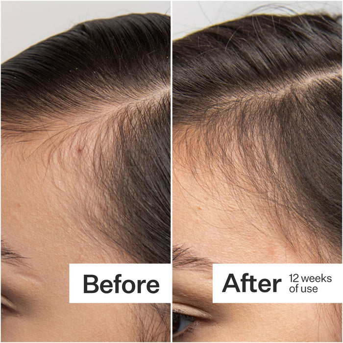 Act+Acre Scalp Dermaroller 0.25mm.