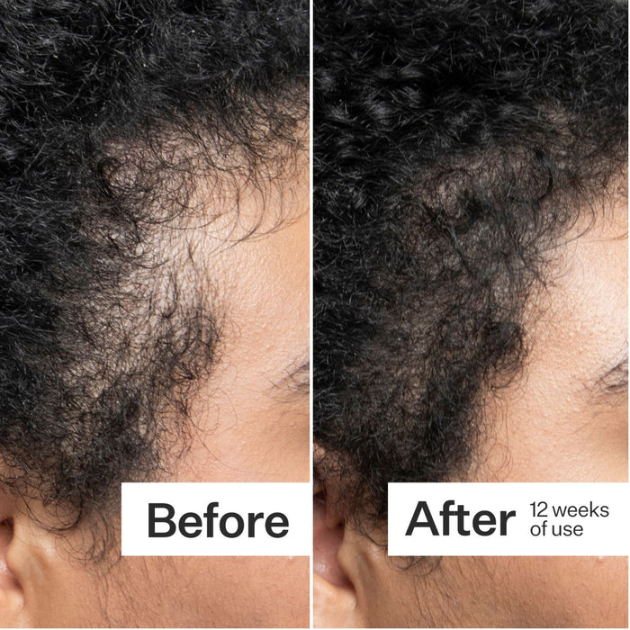 Act+Acre Scalp Dermaroller 0.25mm.