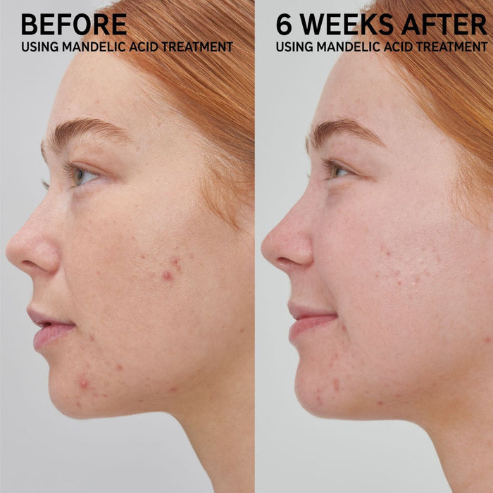 Inkey List Mandelic Acid Treatment